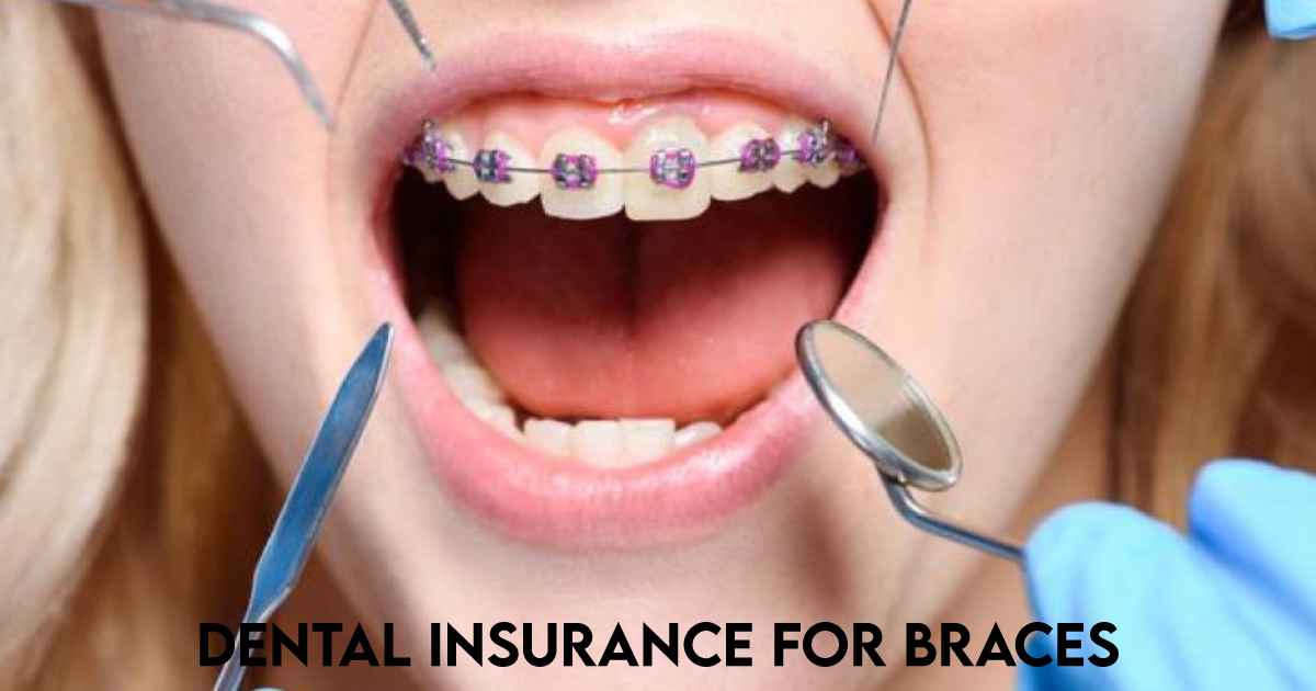 Dental-Insurance-For-Braces